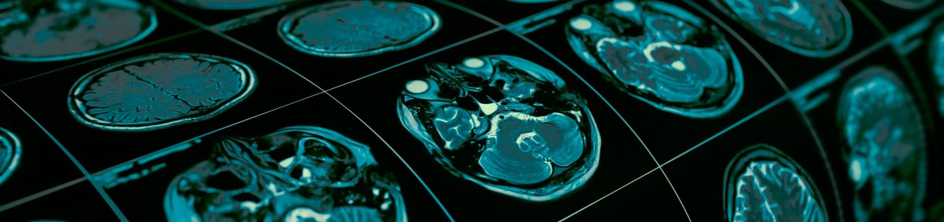 Conheça os principais tratamentos para Doença de parkinson
