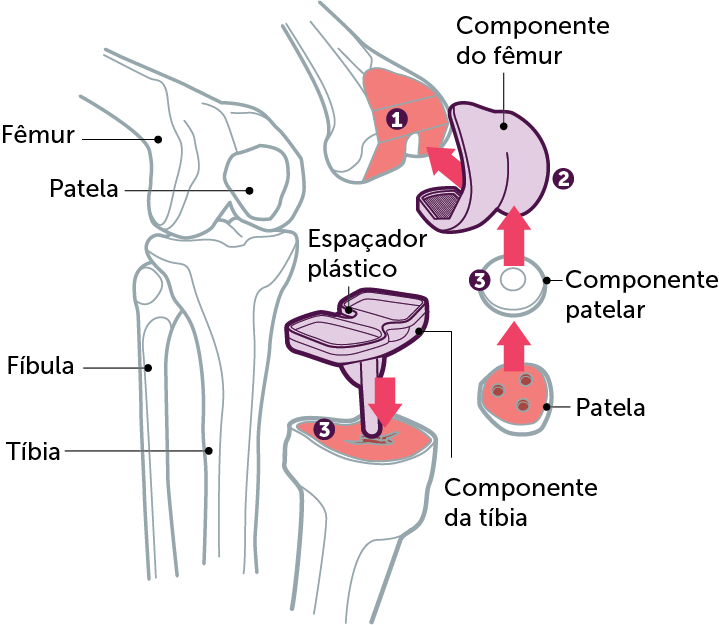 Artroplastia