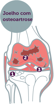 Artrose no joelho