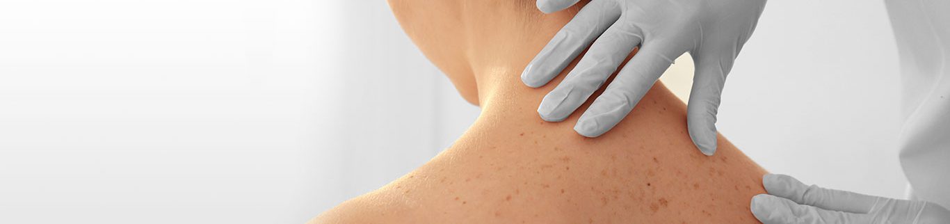 Dermatologista do HCor alerta sobre pintas que podem sinalizar câncer de pele