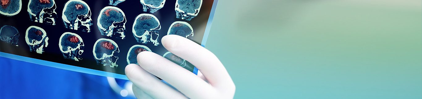 Neurologista do HCor dá dicas para diminuir o risco de AVC
