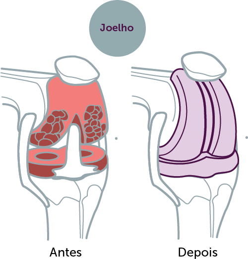 Artroplastia de joelho