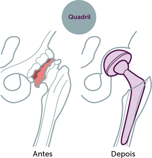 Artroplastia de quadril