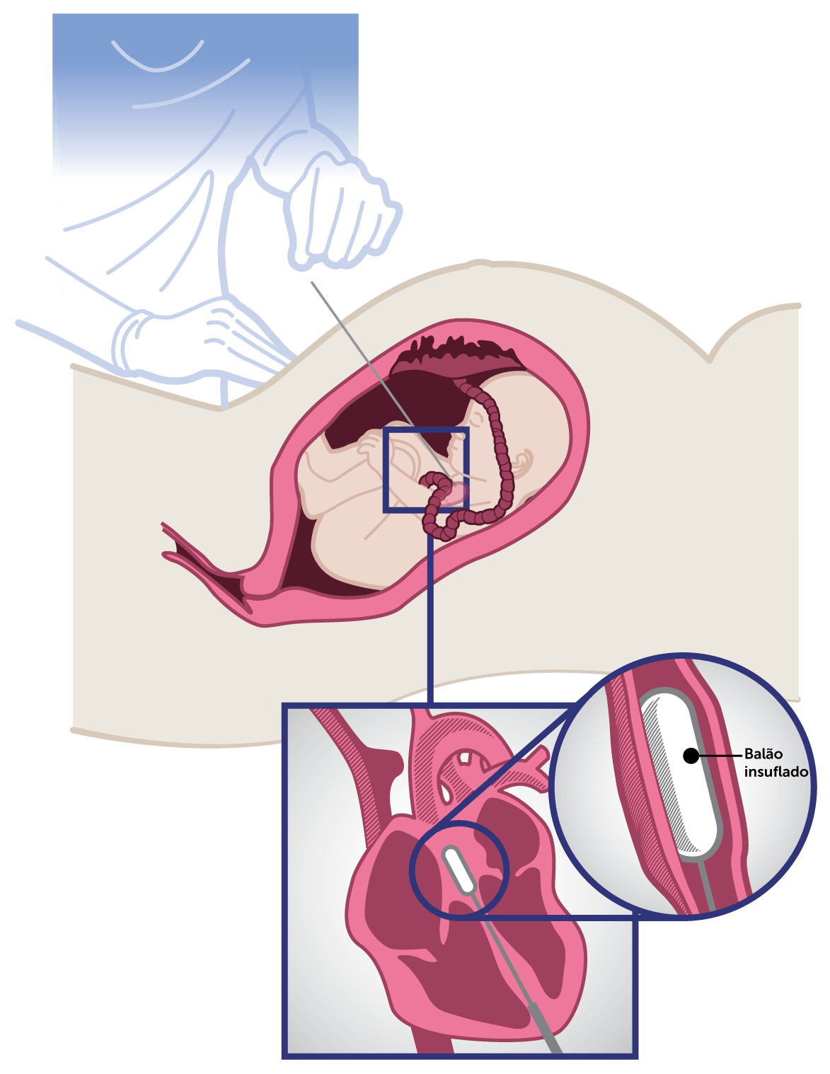 A cirurgia fetal é realizada com a mãe e o bebê sob anestesia Cirurgia fetal
