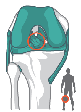 Ligamento cruzado anterior