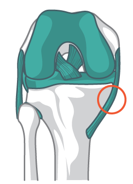 Ligamento colateral