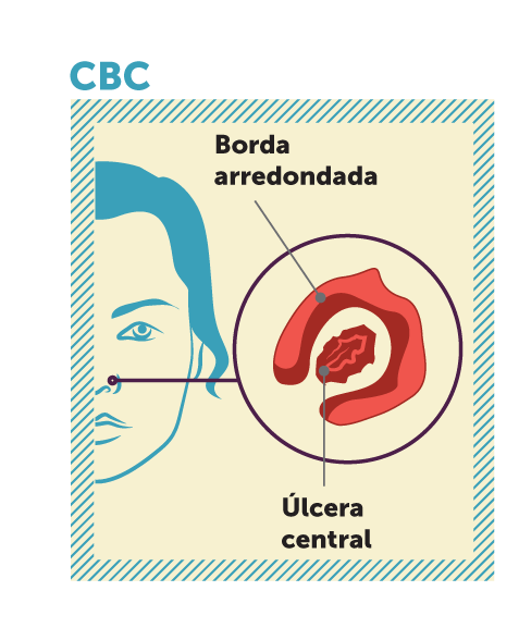 Carcinoma basocelular