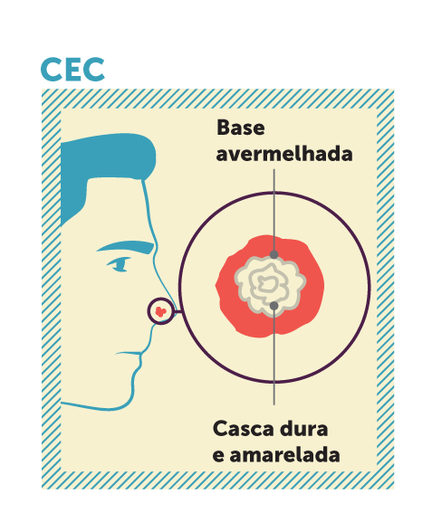Carcinoma espinocelular
