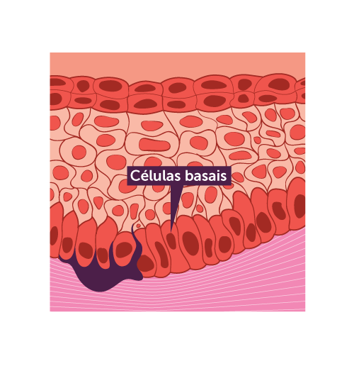 O Carcinoma Basocelular surge na camada mais profunda da epiderme Câncer de pele - carcinoma basocelular