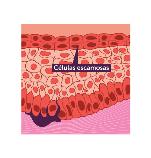 O Carcinoma Espinocelular é o segundo mais comum tipo de câncer de pele Câncer de pele - carcinoma espinocelular