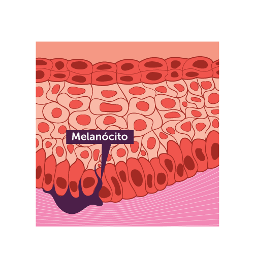 Câncer de pele - Melanoma