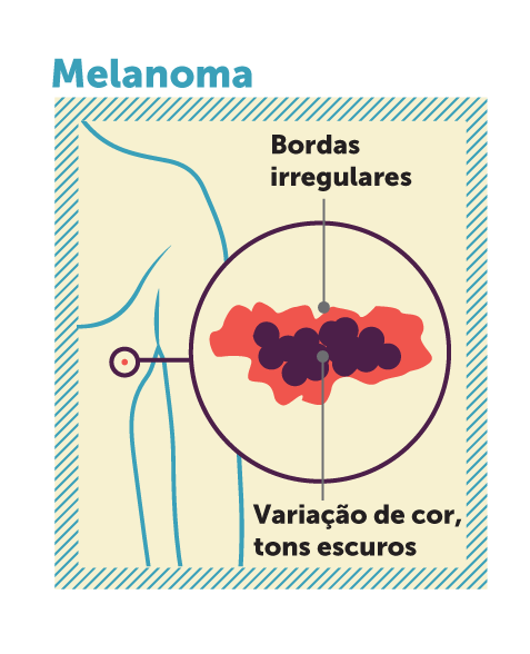 Melanoma