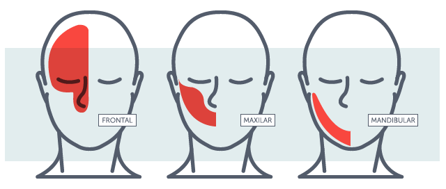 Tipos de neuralgia do trigêmeo