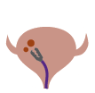 Ressecção transuretal endoscópica