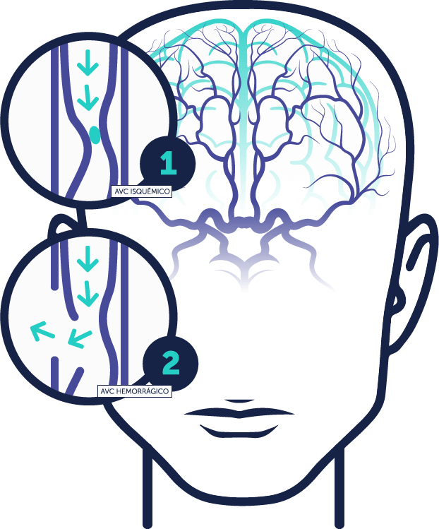 AVC Isquêmico e AVC Hemorrágico