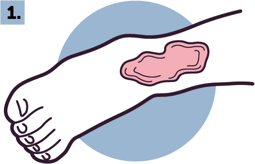 Exemplo de microcirurgia reconstrutiva com queimadura