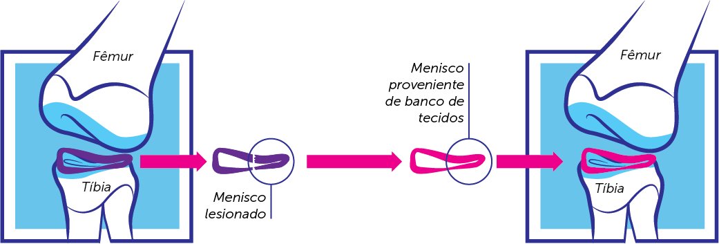 A substituição da estrutura do menisco lesionado por um menisco proveniente de bancos de tecidos.