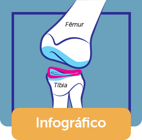 Infográfico sobre o tratamento de lesão no menisco