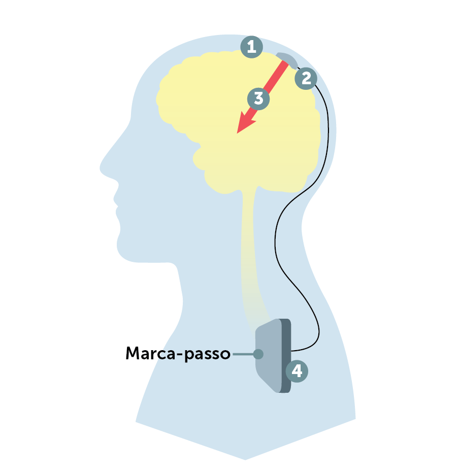 Vetor indicando a localização que conecta o marca-passo com cérebro