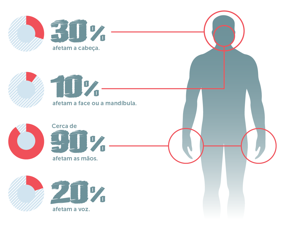Infográfico: 30% afeta a cabeça, 10% afetam a dace ou a mandíbula, 90% afetam as mãos,20% afetam a voz